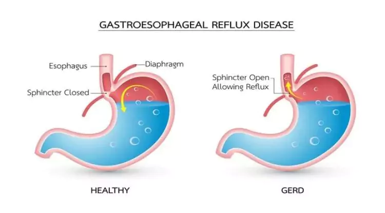 Gejala GERD dan Cara Menghindari GERD