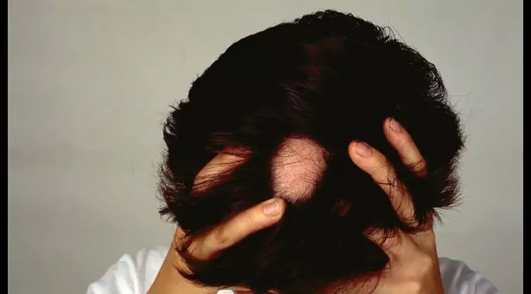 Massive Loss? Beware Alopecia Areata!