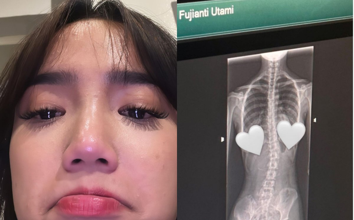 Fuji Utami Beberkan Penyebab Dirinya Alami Skoliosis, Diduga Karena 2 Hal Ini